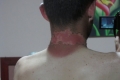2010 12 02 What happens when you don't cover your neck properly.....